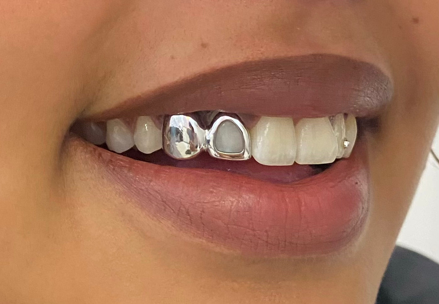 Dent pleine + contour